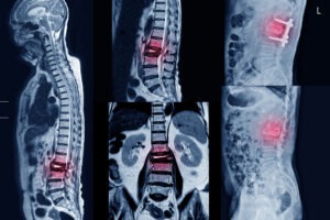 Pasadena Spinal Cord Injury Lawyer