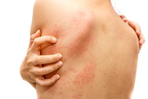 Sarasota FL allergic reaction lawyer