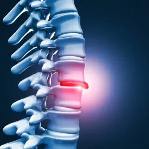 Clearwater Herniated Disc Lawyer