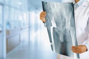 Sarasota Hip Replacements Defect Lawyer