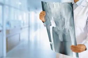 Hip Replacements Defect