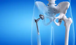 A skeletal view of a hip replacement
