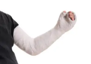 man in an arm cast