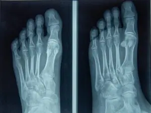 x-ray of foot and toes