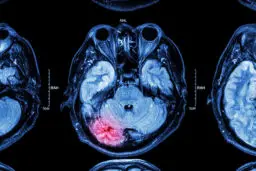 how to spot the brain injury symptoms