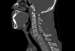 An X-ray showing a severe spinal cord injury. Seek legal help after your injury by contacting our El Dorado Hills spinal cord injury team.