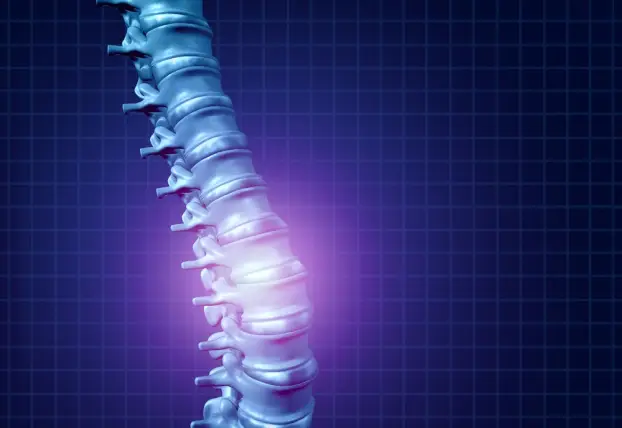 An image of a damaged spinal cord. Contact our Elk Grove spinal cord injury lawyers today for a free consultation.