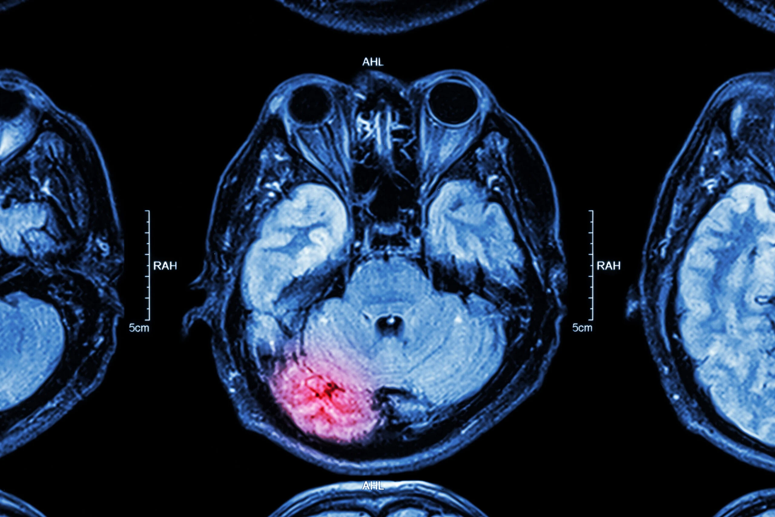 mri-of-a-brain-injury