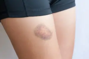 Close up of a bruise on a young woman thigh as the result of an injury accident