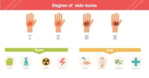 An illustrated chart that shows the different categories of burn injuries