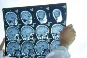 a-doctor-examining-brain-scan-to-see-if-a-brain-injury-has-occurred